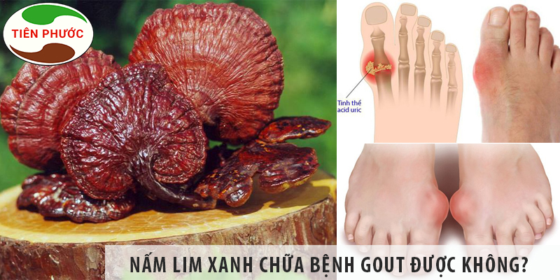 Nấm Lim Xanh Chữa Bệnh Gout được Không?